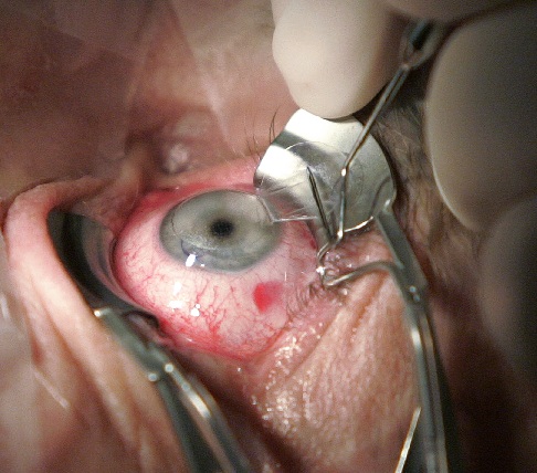 Lasik Surgery